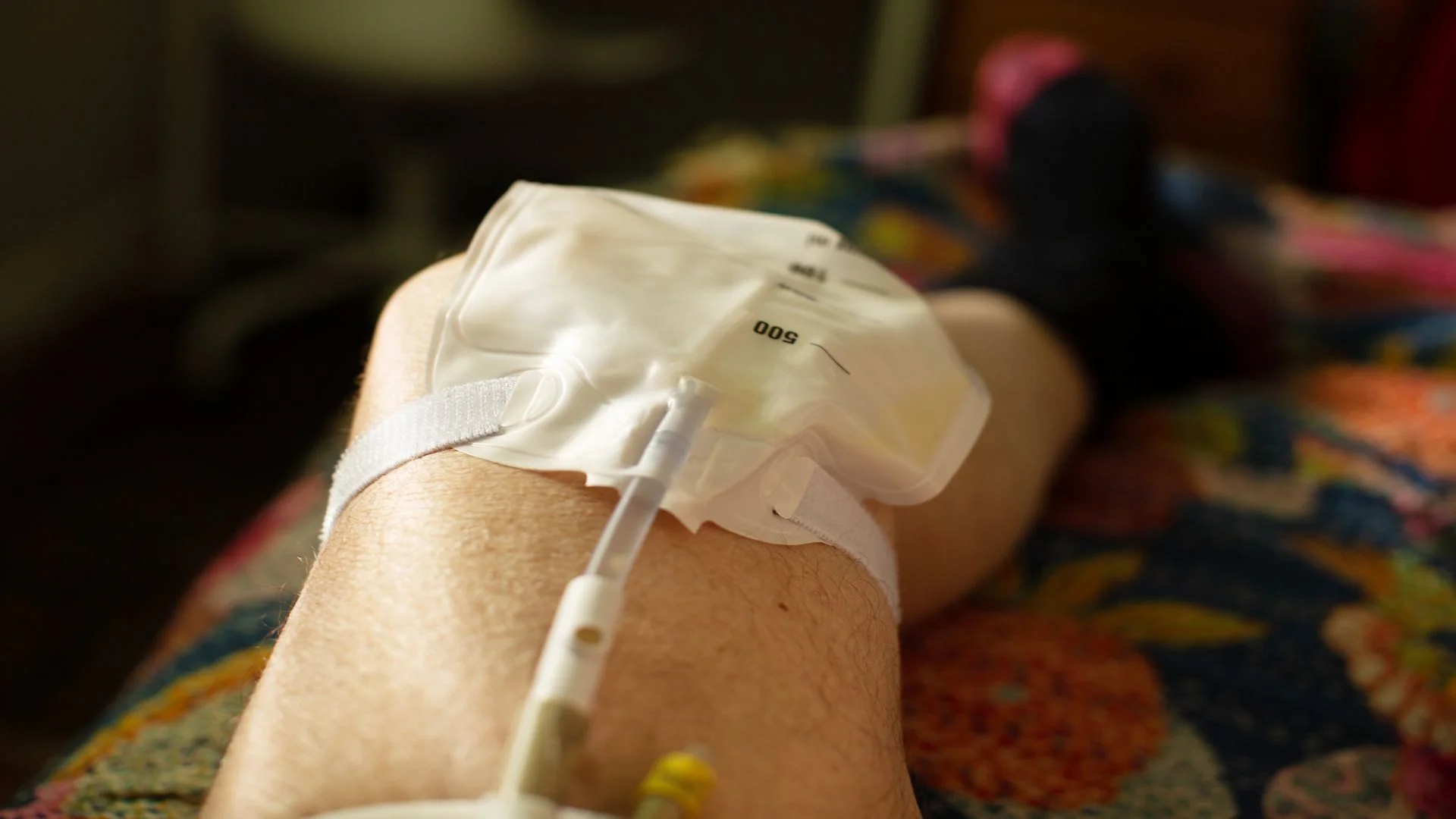 A catheter drainage bag is secured with straps on a leg in Central & Southern Florida