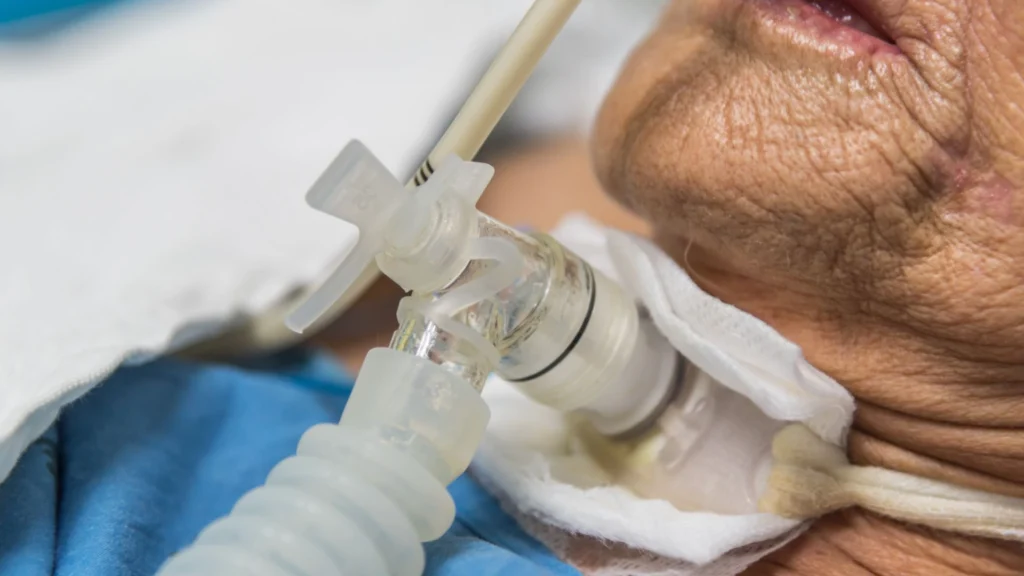 Tracheostomy tube inserted in a patient’s neck for breathing support in Central & Southern FL